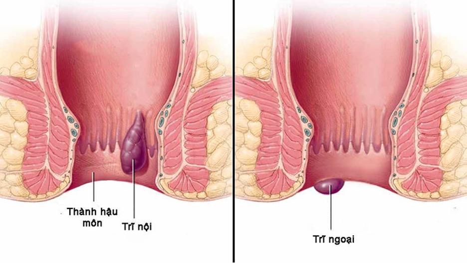 5 thủ phạm ‘giấu mặt’ gây ra nỗi ám ảnh mang tên bệnh trĩ - Ảnh 1. bệnh trĩ - Ảnh 1.