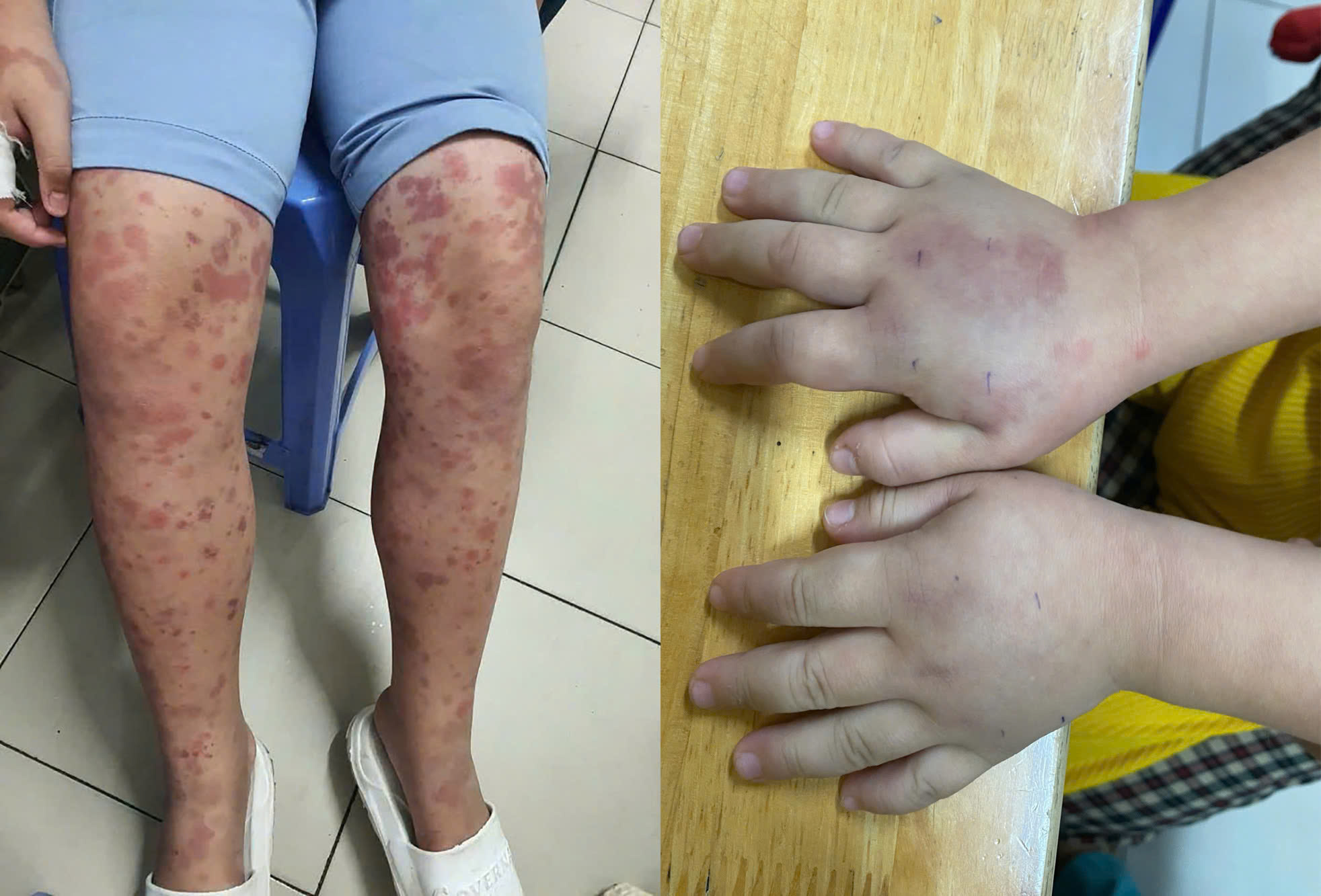 ban xuất huyết Schonlein - Henoch - Ảnh 1.