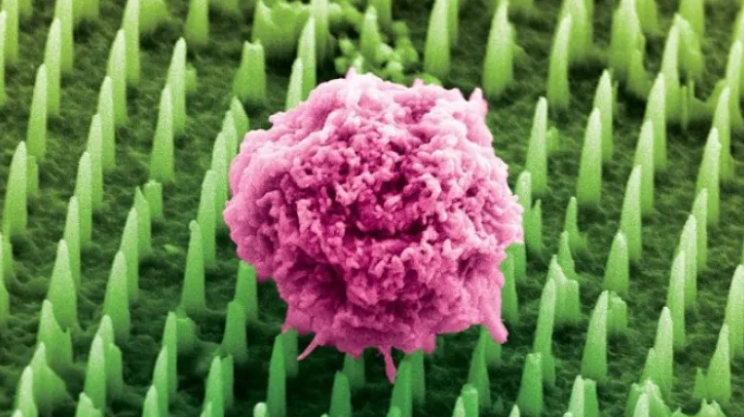 Σημαντική ανακάλυψη στη διάγνωση του καρκίνου: Τα μικροεπιθέματα αντικαθιστούν τις βιοψίες - Φωτογραφία 1. Đột phá trong chẩn đoán ung thư: Miếng dán siêu nhỏ thay thế sinh thiết - Ảnh 1.