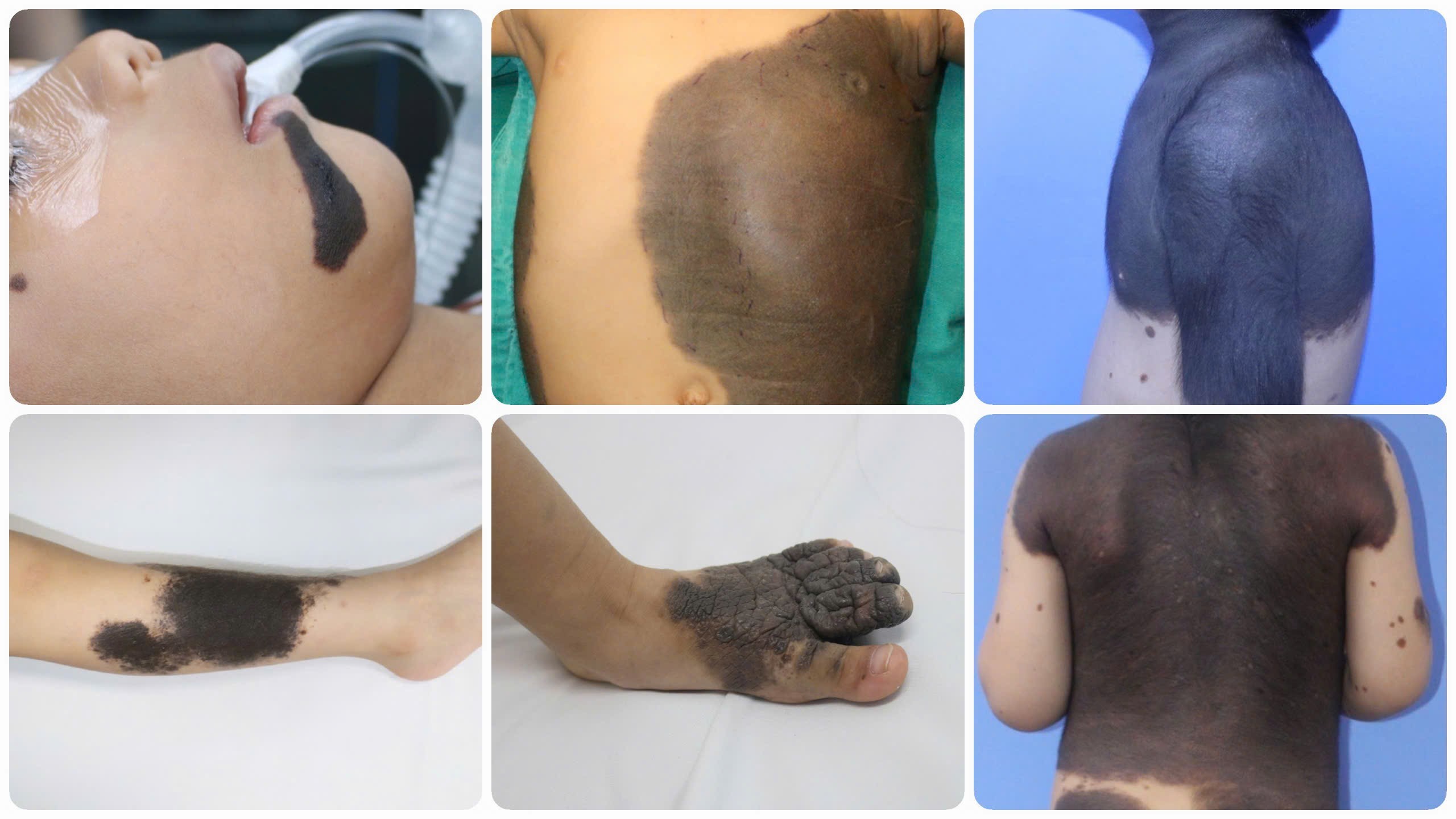 Những mảng đen trên da trẻ, không chỉ là thẩm mỹ mà còn tiềm ẩn nguy cơ ung thư - Ảnh 1. ung thư - Ảnh 1.