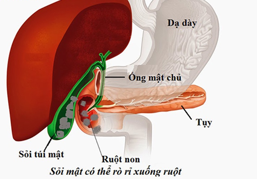 Viên sỏi túi mật: ‘Quả bom nổ chậm’ gây tắc ruột - Ảnh 1. sỏi túi mật - Ảnh 1.