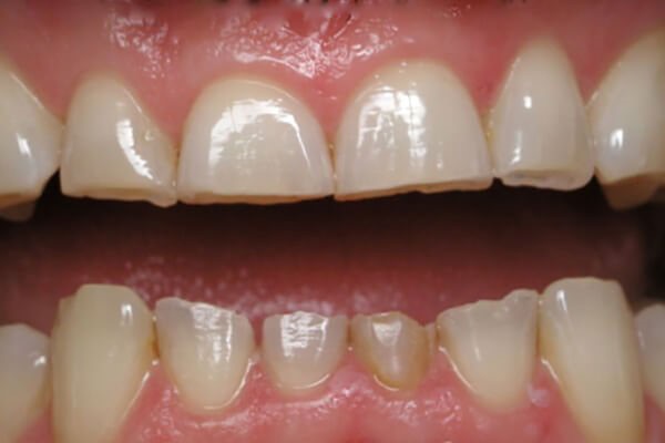 Tại sao nhiều người ngủ lại nghiến răng, có điều trị được không? - Ảnh 1. tật nghiến răng - Ảnh 1.
