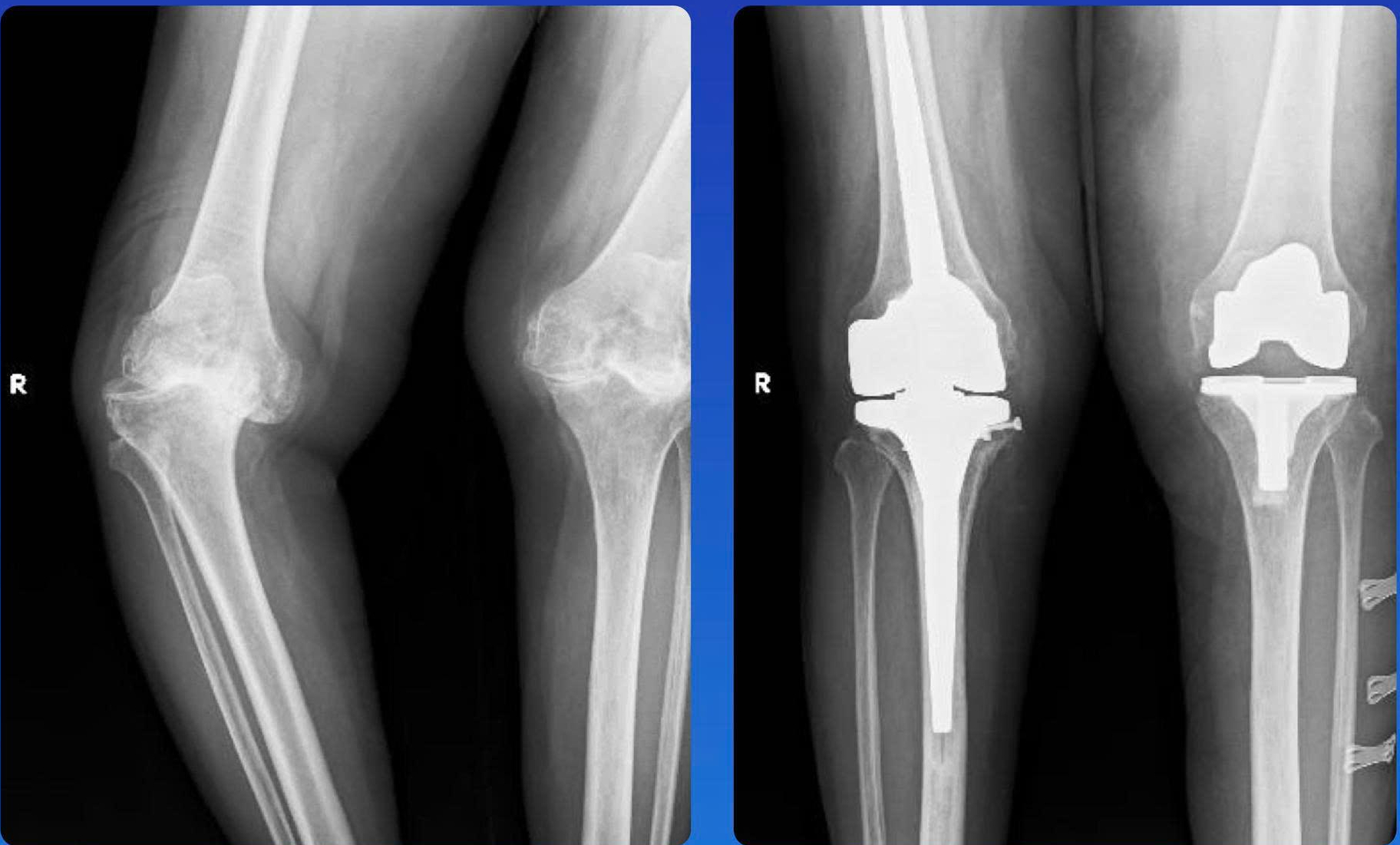 Lấy lại dáng đi cho người phụ nữ 69 tuổi nhờ kỹ thuật thay khớp gối bản lề - Ảnh 2.