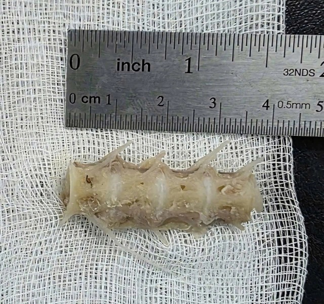 Hóc đoạn xương sống cá 4cm trong cổ, cụ ông 99 tuổi nguy kịch - Ảnh 1.