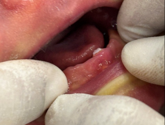 Trẻ sơ sinh có răng mọc ngay lúc sinh, hiện tượng hiếm gặp hay kỳ lạ? - Ảnh 2.