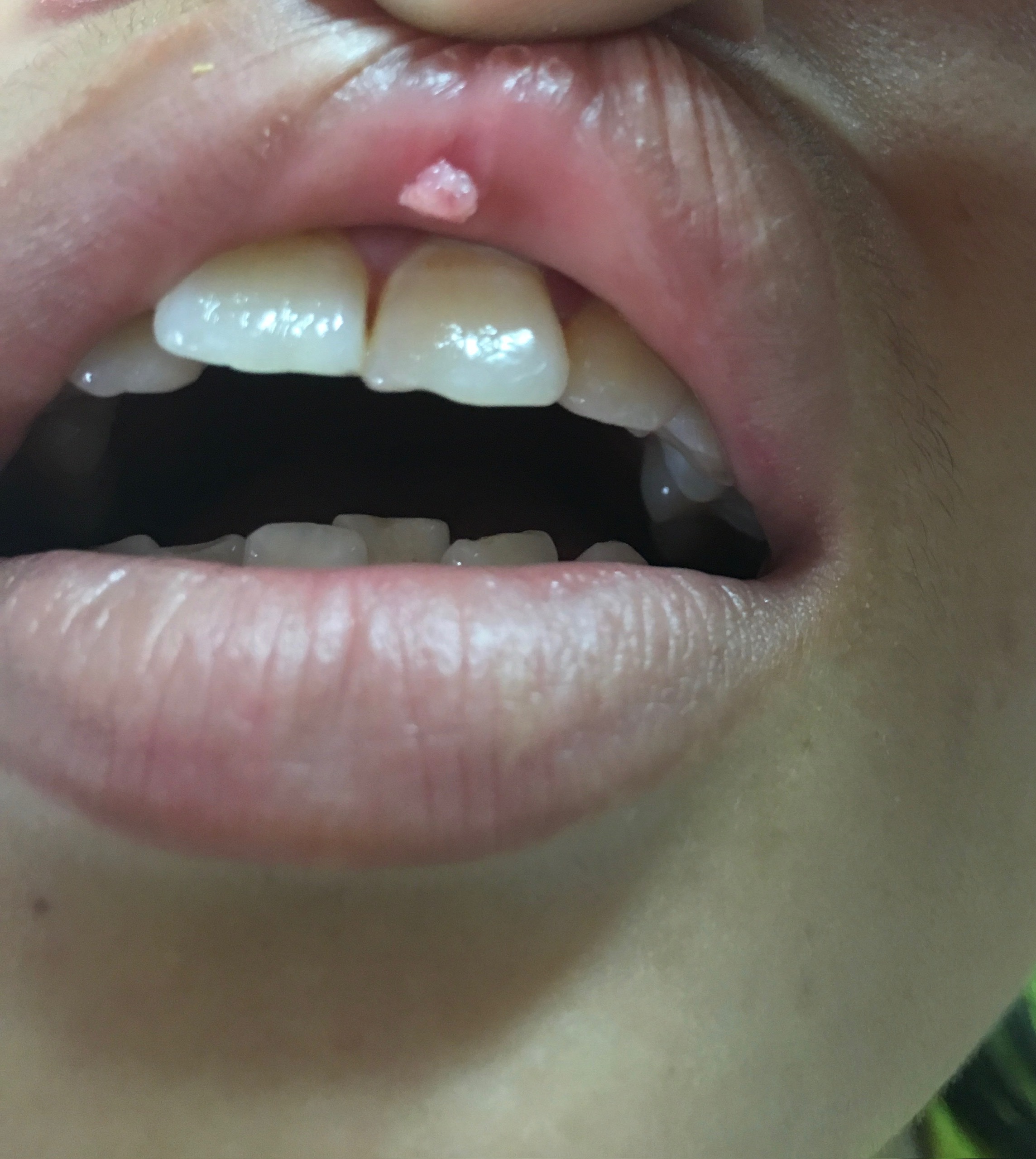 Oral sex tưởng an toàn, cô gái trẻ mắc sùi mào gà ở miệng - Ảnh 1.