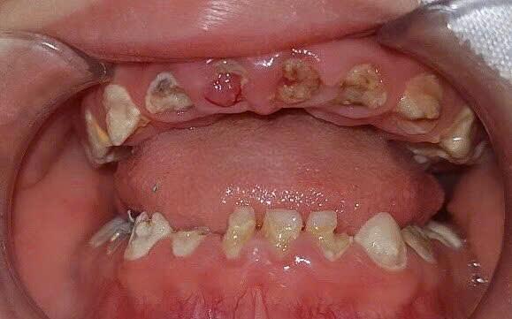 Những ảnh hưởng tới răng, xương hàm, gia đình có trẻ bú bình cần biết - Ảnh 2.