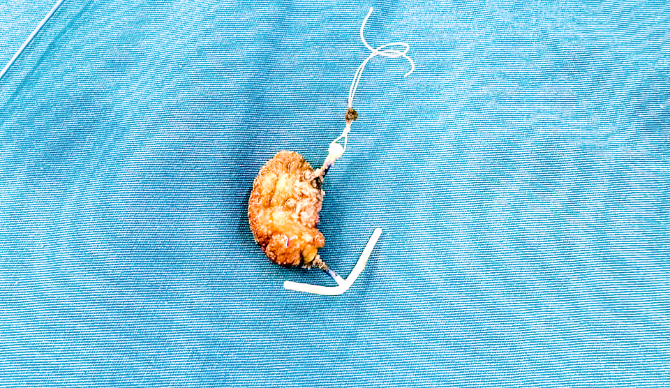 VÒNG TRÁNH THAI - Ảnh 1.