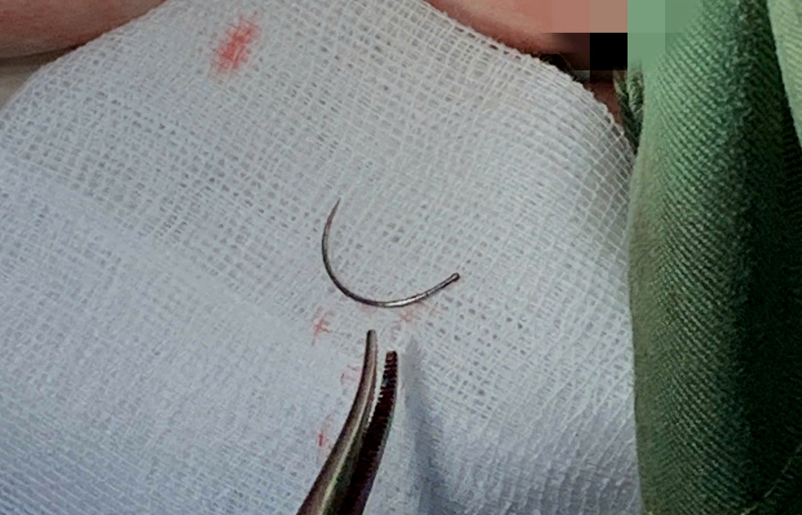 Lấy dị vật kim khâu nằm trong tầng sinh môn nữ bệnh nhân sau 11 năm - Ảnh 1.