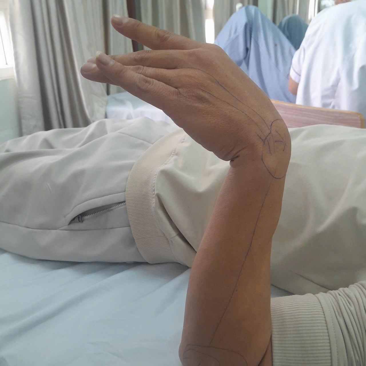 Ngủ gật gối đầu lên tay, người đàn ông 37 tuổi bị liệt thần kinh quay - Ảnh 1. ngủ gật - Ảnh 1.