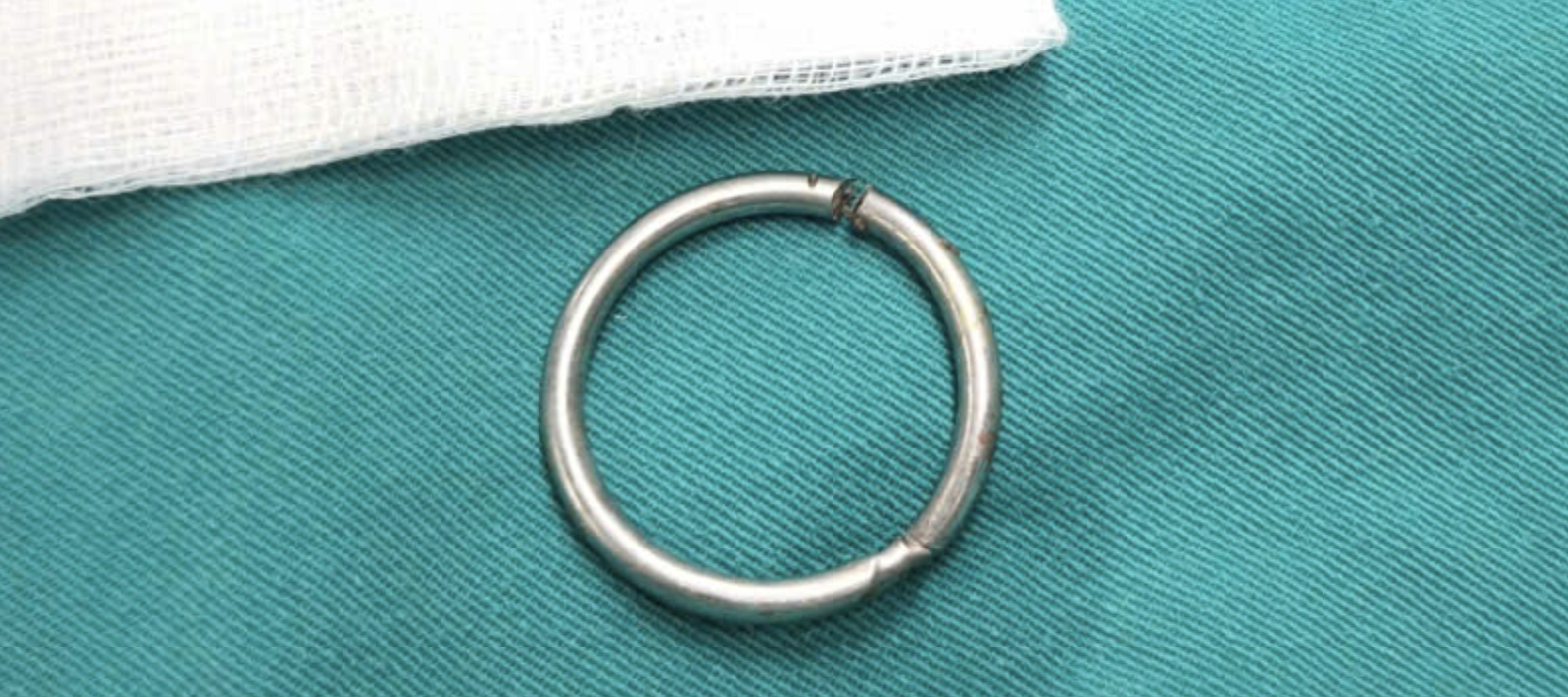 Suýt hoại tử tinh hoàn vì tự đeo vòng kim loại 3cm - Ảnh 3.