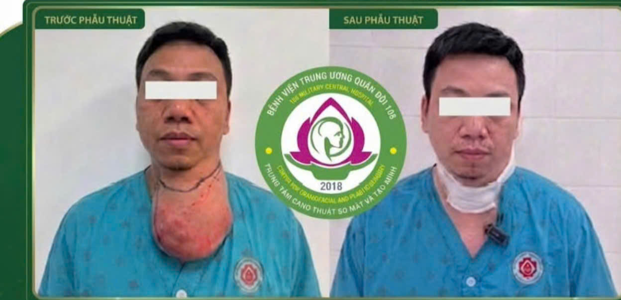 Lấy khối u khổng lồ ở cổ, làm sao bảo tồn mạch máu và dây thần kinh? - Ảnh 2.