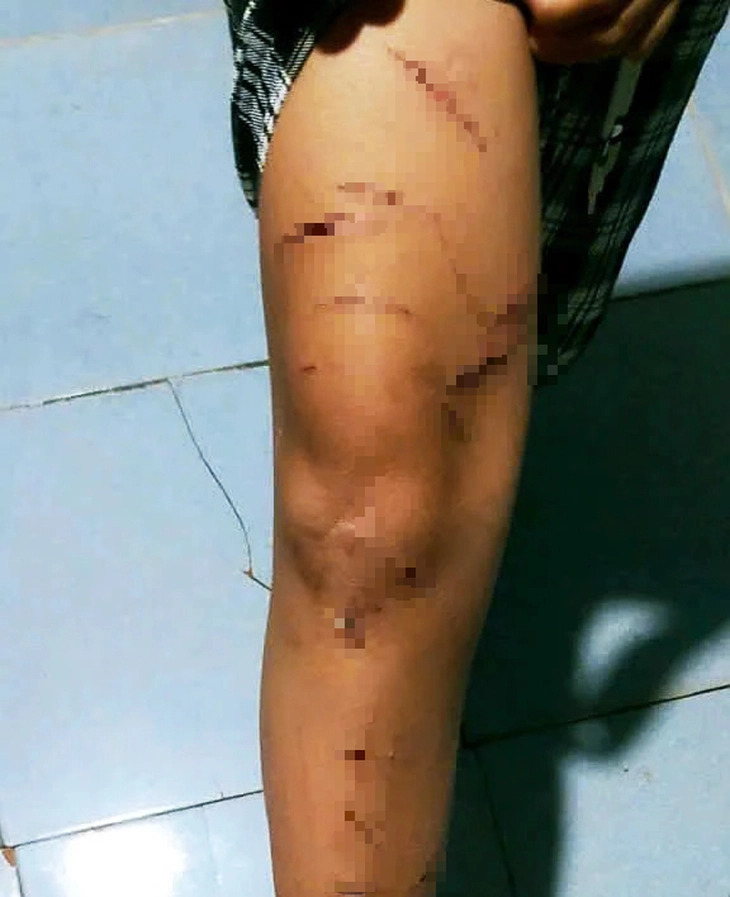 Bé gái lớp 5 bị chị họ dùng dao rạch nhiều vết trong 6 ngày tại nhà bà ngoại