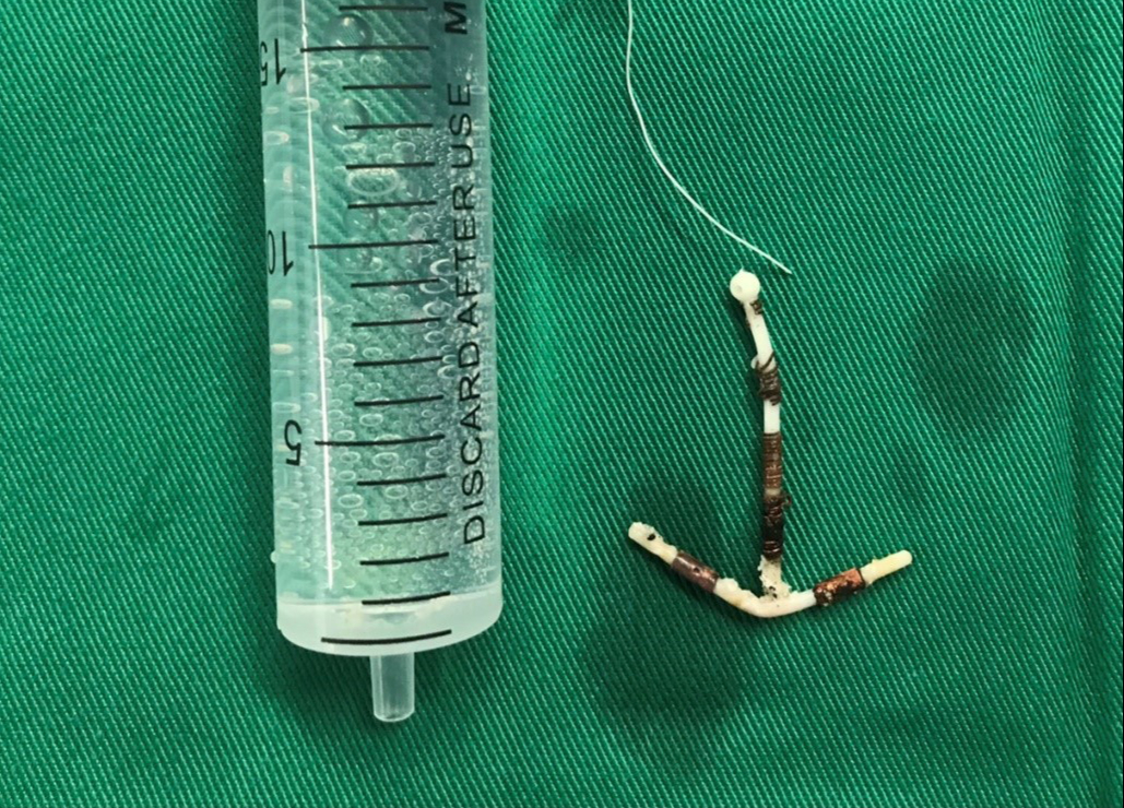 Lấy vòng tránh thai lạc chỗ suốt ¼ thế kỷ - Ảnh 1. tránh thai - Ảnh 1.