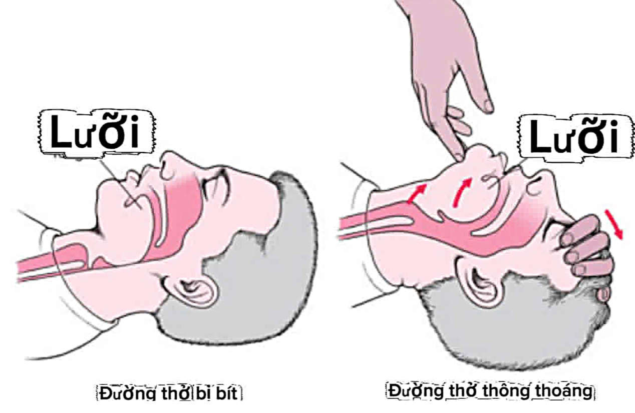 Đừng kéo lưỡi khi cấp cứu 'nuốt lưỡi' - Ảnh 1. nuốt lưỡi - Ảnh 1.
