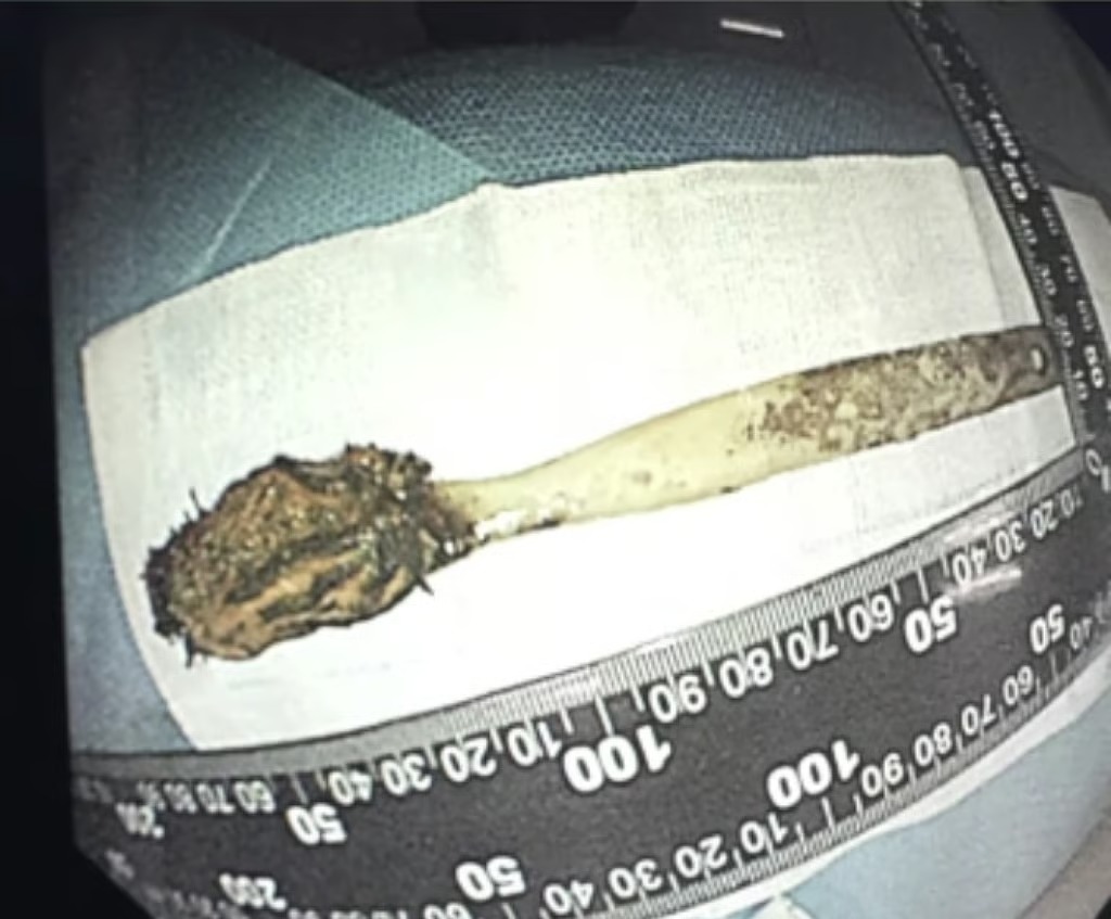 Người đàn ông nuốt nhầm nhiệt kế, 20 năm sau mới 'tá hoả' phát hiện khi đi khám đau bụng - Ảnh 2. nhiệt kế - Ảnh 2.