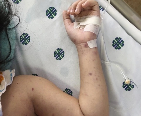 viêm màng não mô cầu - Ảnh 1.