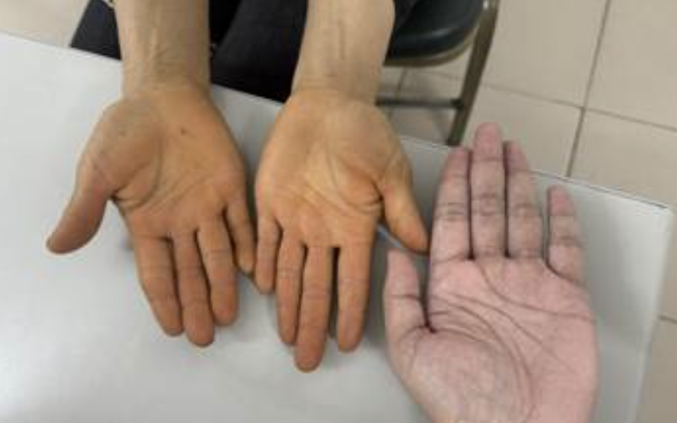 Da Vàng Bất Thường: Đừng Vội Lo Lắng Bệnh Gan, Có Thể Là Dấu Hiệu Từ Chế Độ Ăn Uống