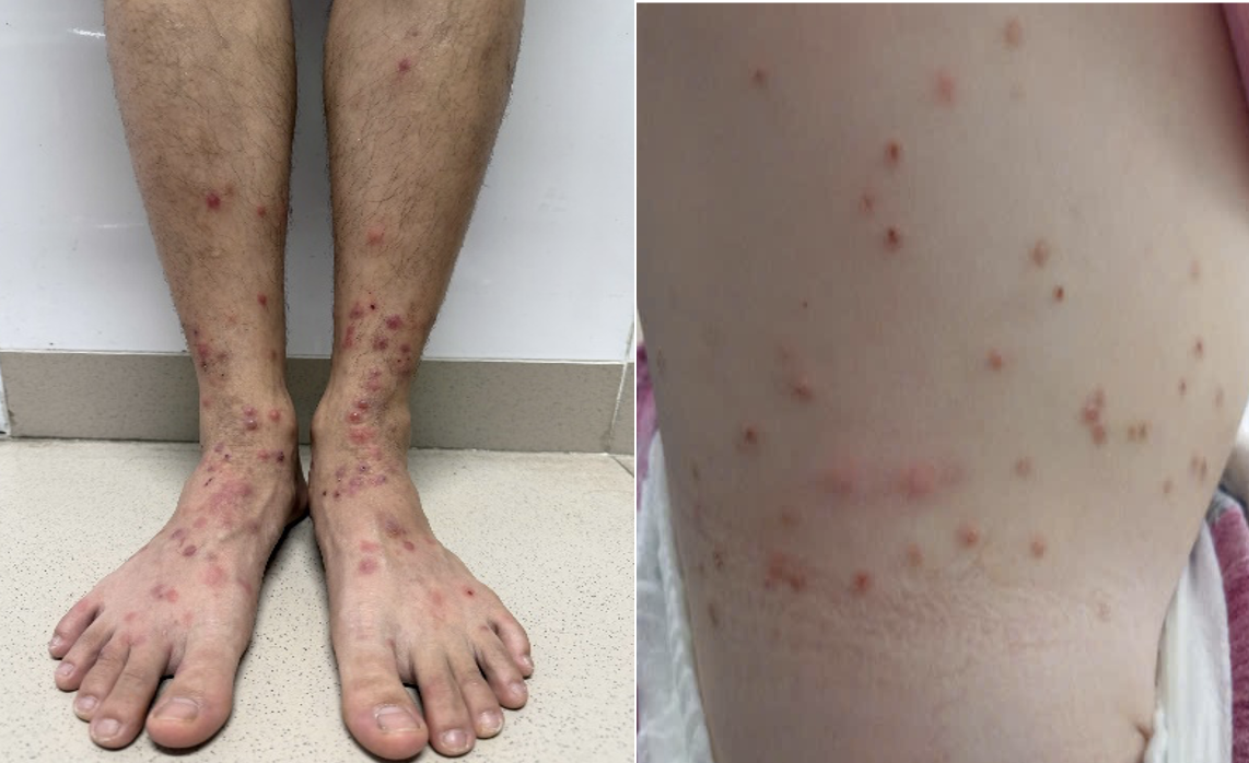 bọ chét - Ảnh 1.