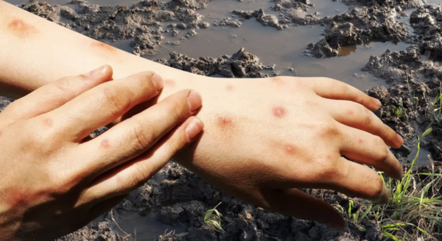 Bệnh Sốt Đất Whitmore: Kẻ Thù Thầm Lặng Từ Lòng Đất và Lá Chắn Phòng Ngừa Toàn Diện