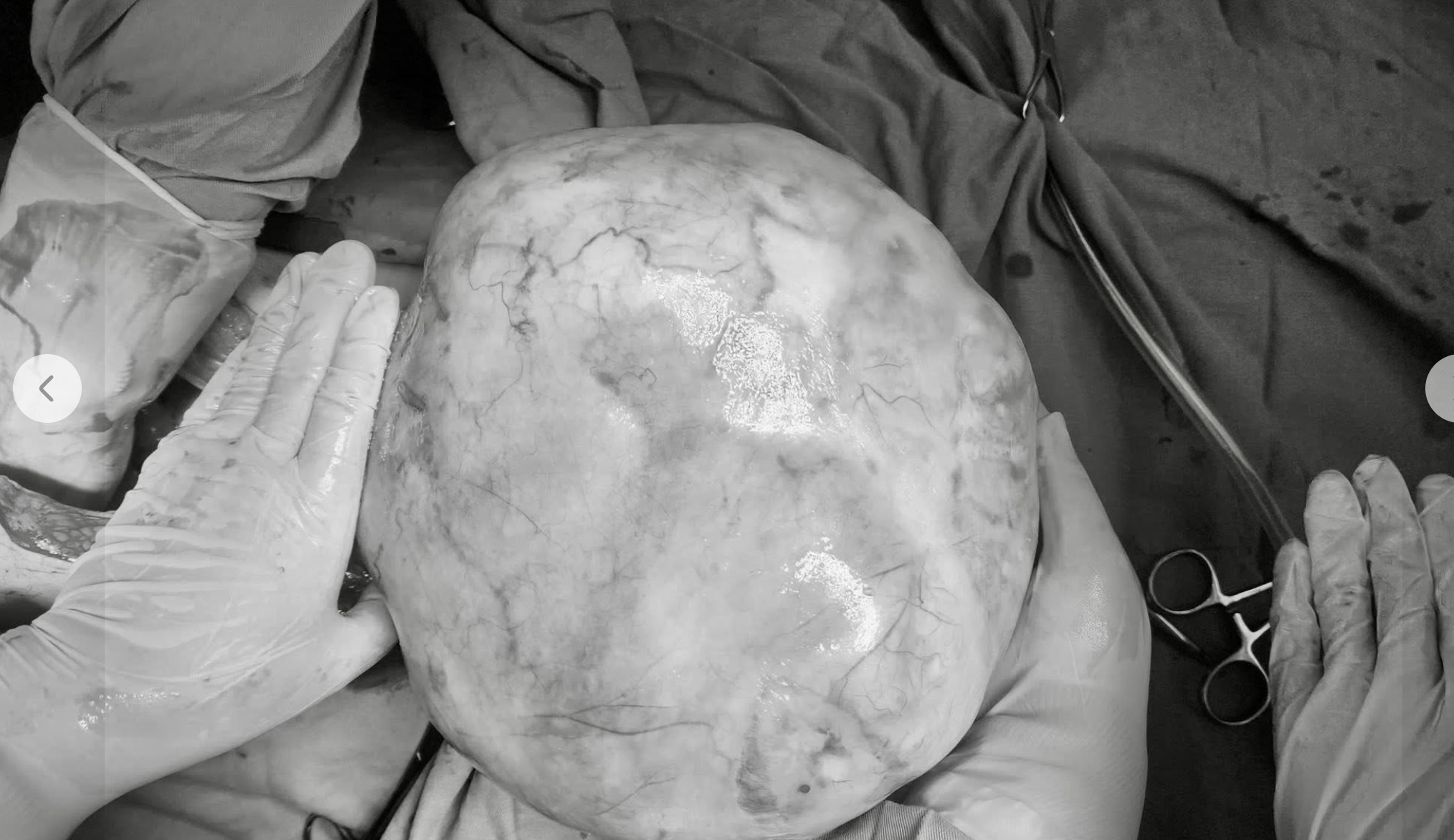 u buồng trứng - Ảnh 1.