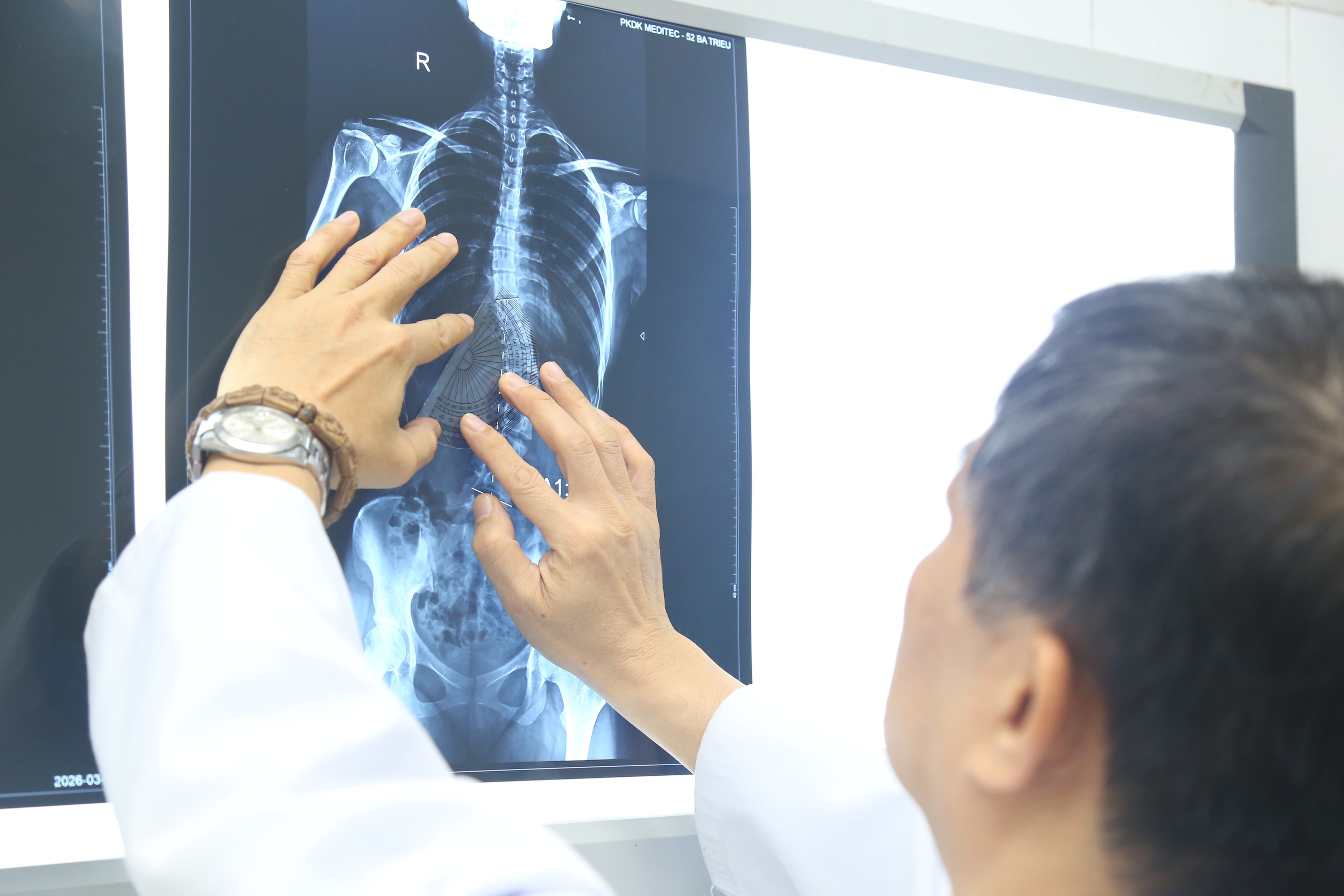 Nhiều trẻ vẹo cột sống nặng mới đi khám, chuyên gia cảnh báo nguy cơ biến chứng nặng - Ảnh 2.