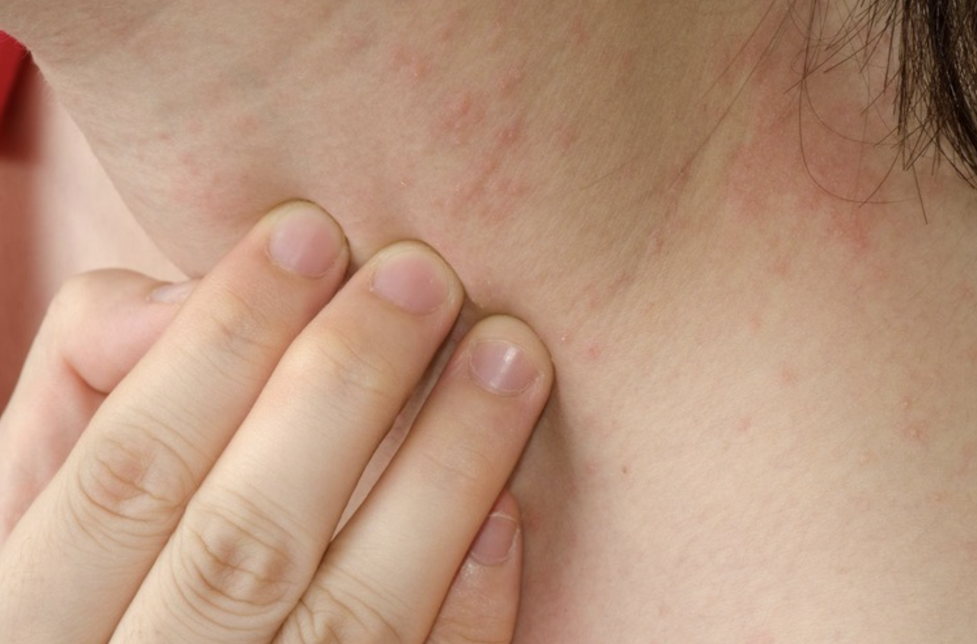 Ngứa kéo dài, có thể là dấu hiệu cảnh báo sớm suy thận - Ảnh 1. suy thận - Ảnh 1.