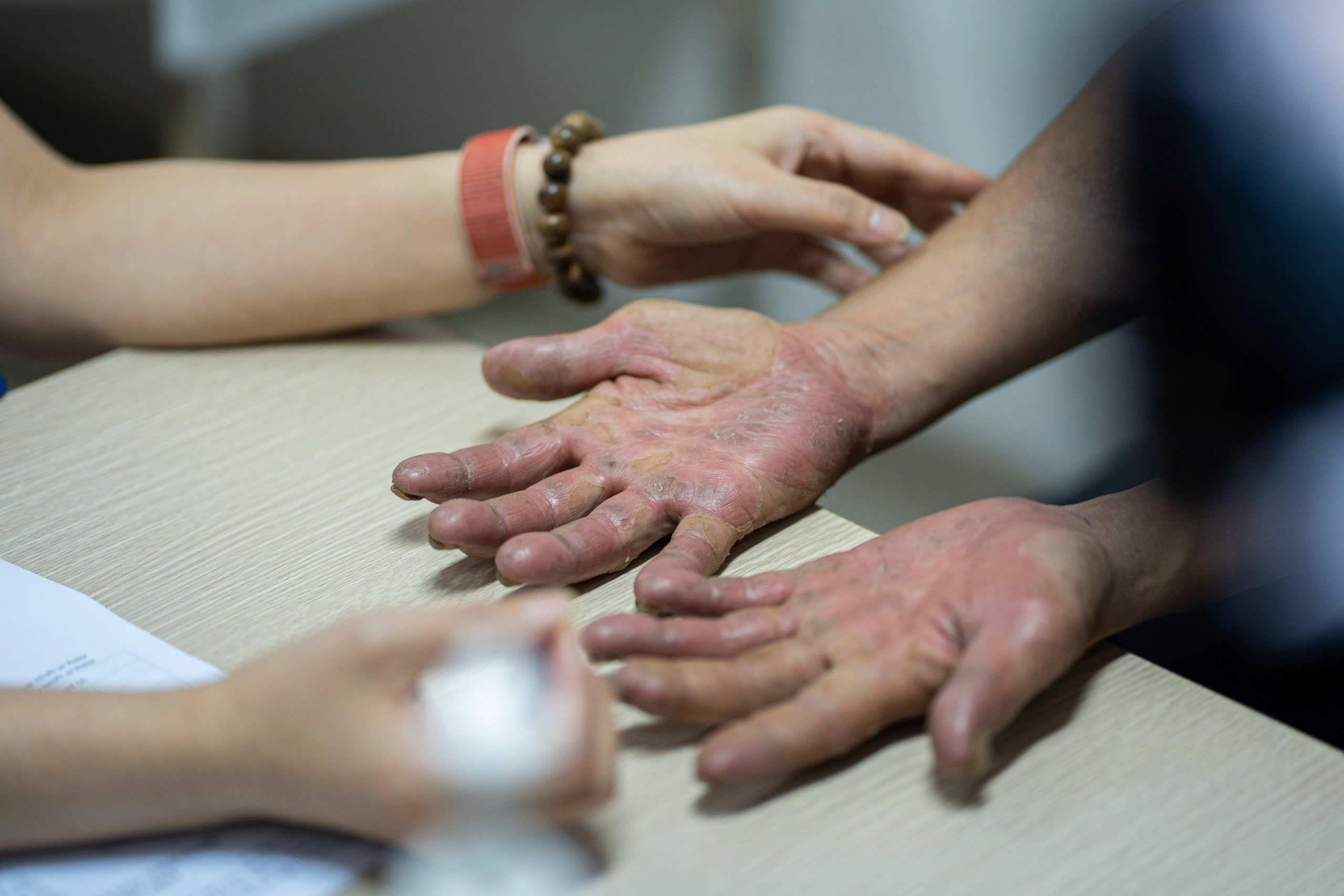 Vừa nắng nóng đầu mùa, bệnh da liễu đã bùng phát: Làm gì để phòng tránh? - Ảnh 1. nắng nóng - Ảnh 1.