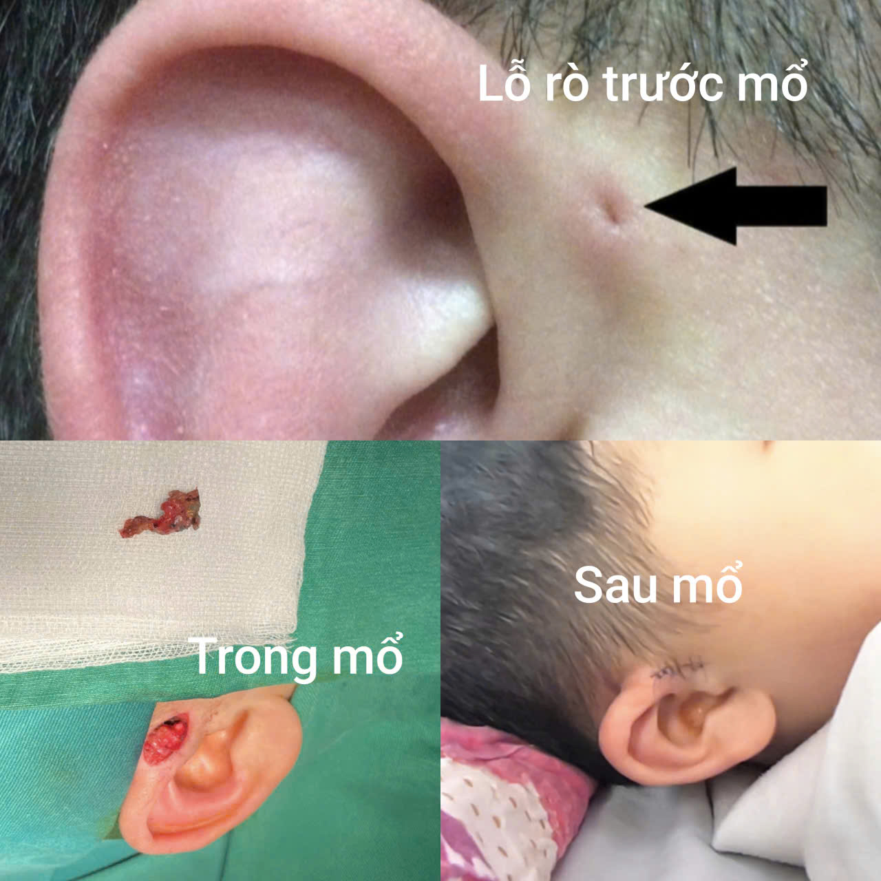 rò luân nhĩ - Ảnh 1.