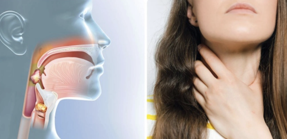 Triệu chứng ung thư vòm họng dễ nhầm với viêm họng, viêm xoang - Ảnh 1. ung thư vòm họng - Ảnh 1.