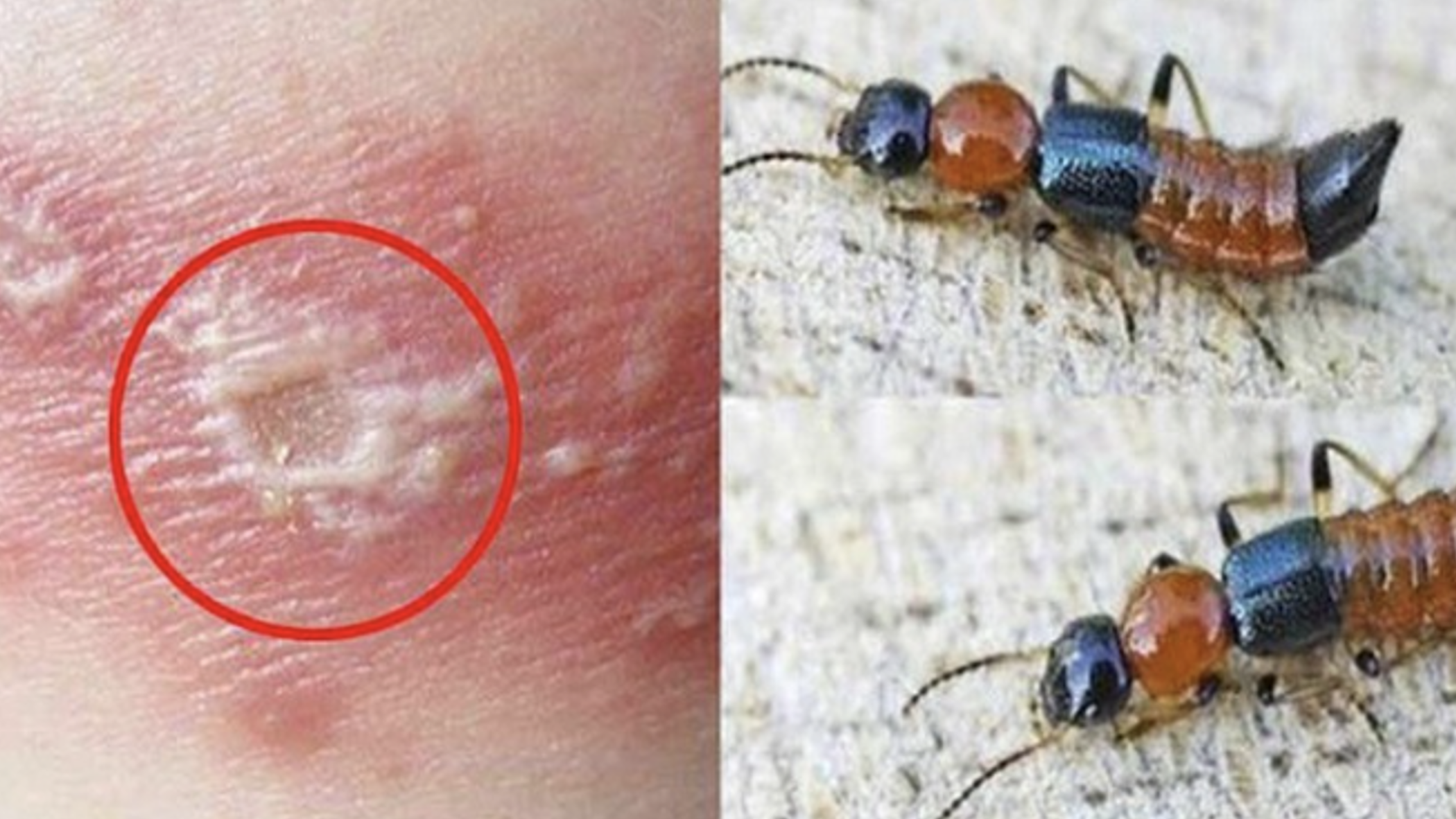 Mùa kiến ba khoang, cẩn trọng nhầm với zona thần kinh - Ảnh 1. Mùa kiến ba khoang, cẩn trọng nhầm với zona thần kinh - Ảnh 1.
