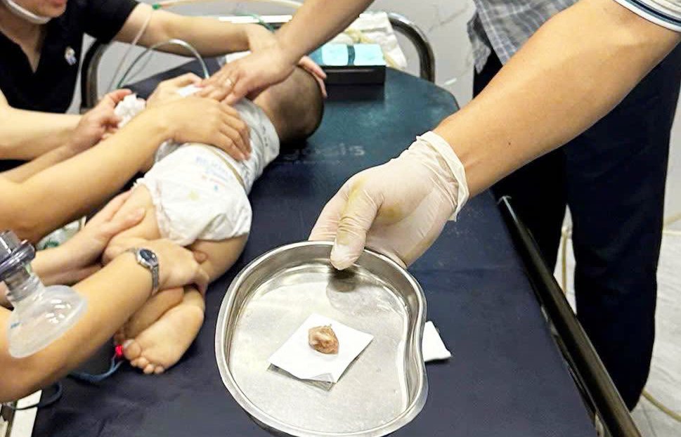 Cứu bé trai 16 tháng tuổi tím tái, suy hô hấp vì hóc hạt chôm chôm - Ảnh 2.