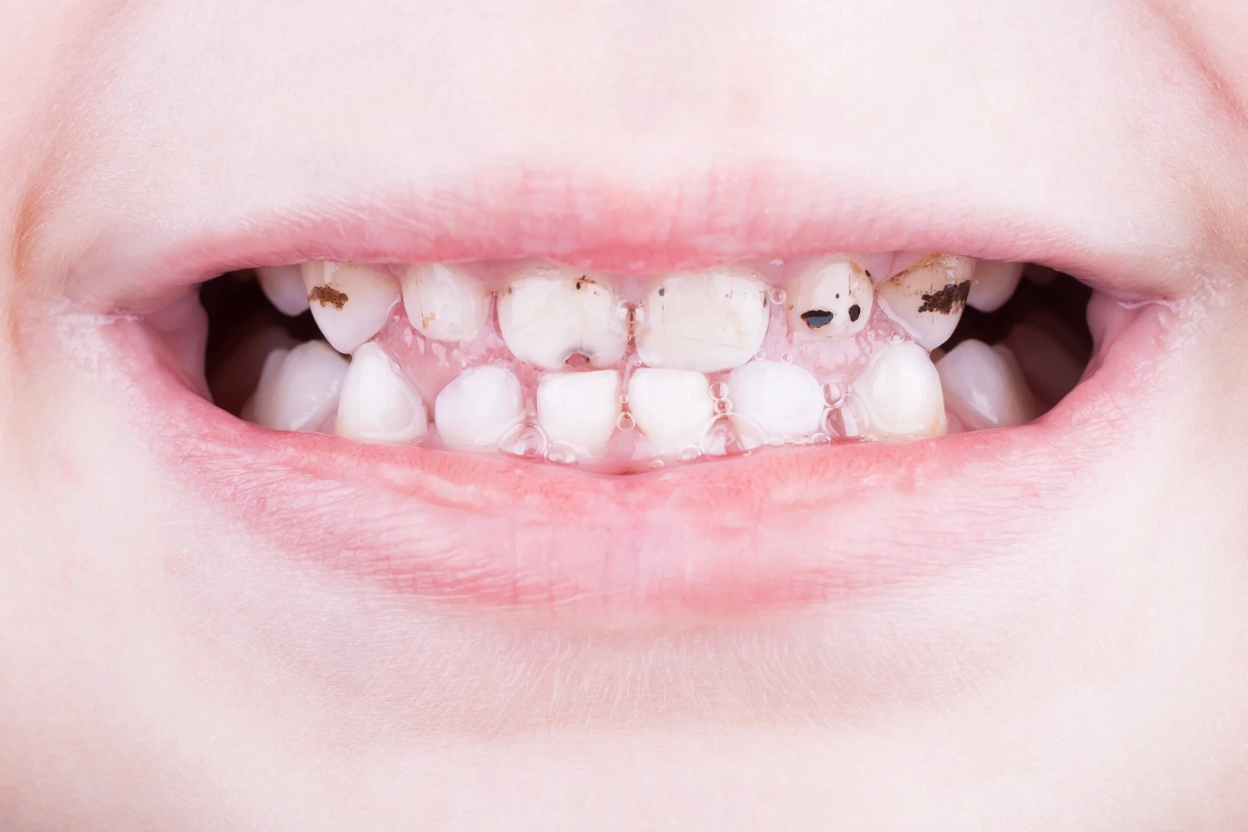 Tìm thấy cách chặn sâu răng bằng dung dịch đặc biệt, không cần khoan - Ảnh 2.