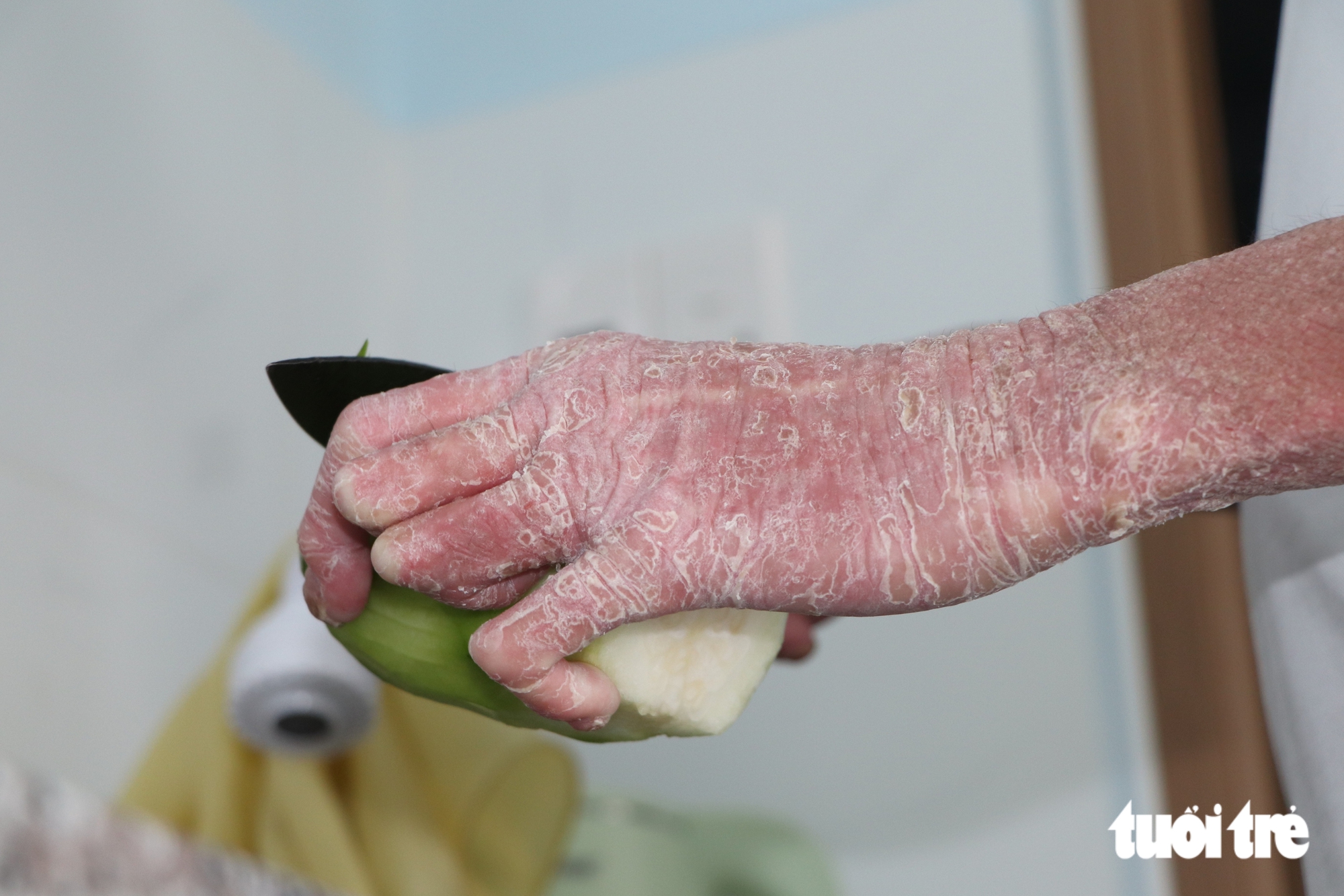 24 tuổi đời tràn ngập nỗi đau, nam sinh 'người rắn' dũng cảm bước vào đại học - Ảnh 12.