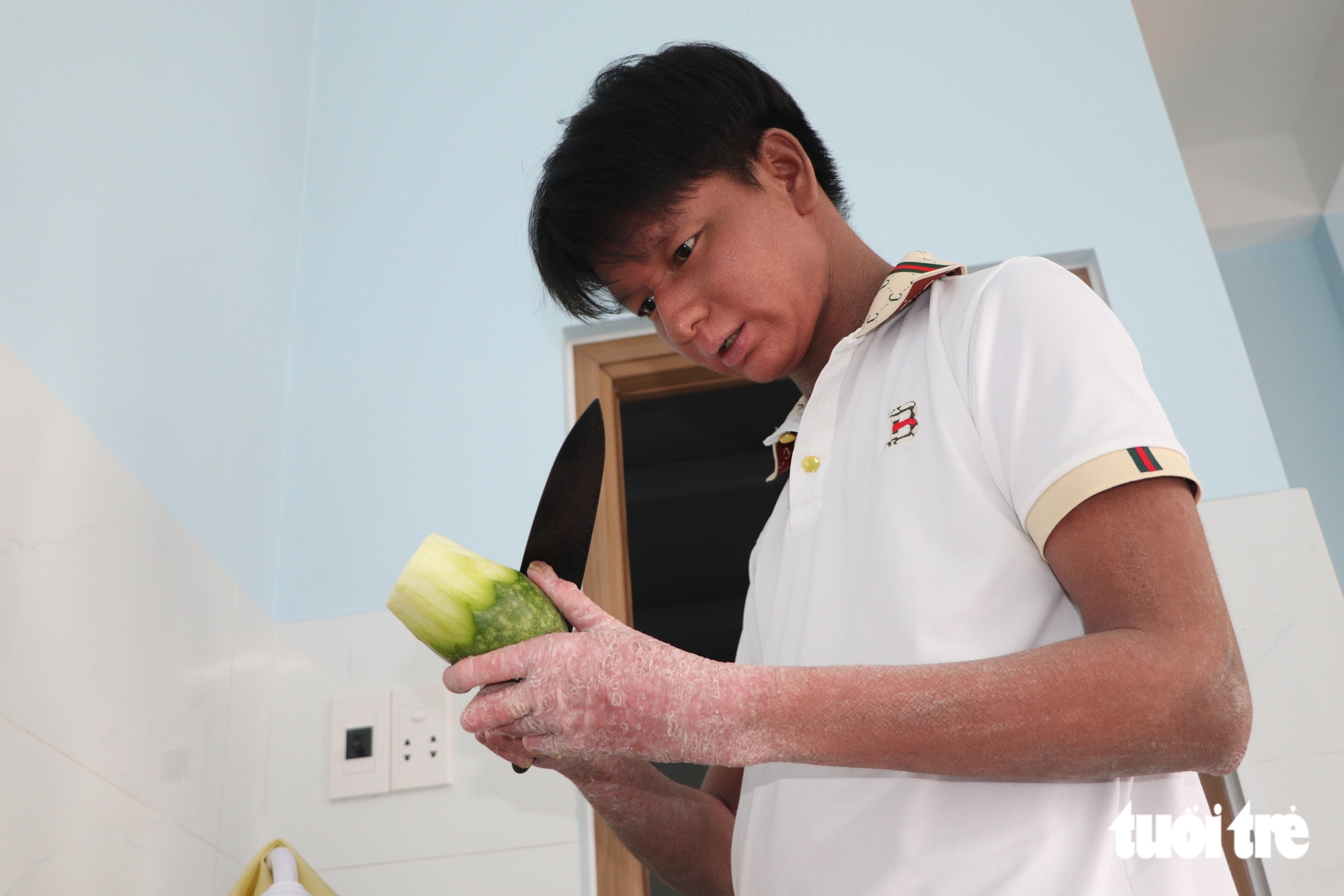 24 tuổi đời tràn ngập nỗi đau, nam sinh 'người rắn' dũng cảm bước vào đại học - Ảnh 14.