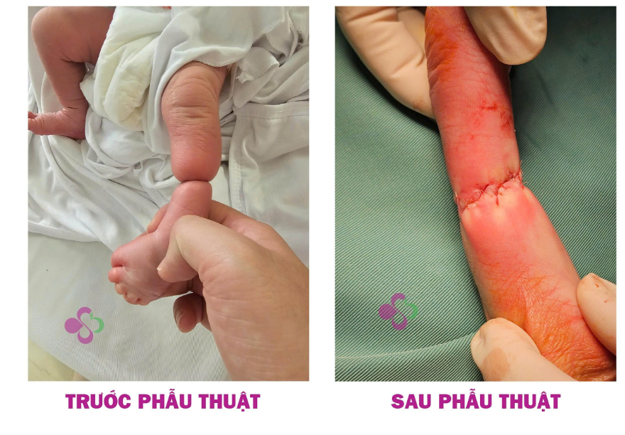 Hy hữu: Trẻ sơ sinh bị hội chứng dải sợi ối từ trong bụng mẹ thắt nghẹt cẳng chân  - Ảnh 1.