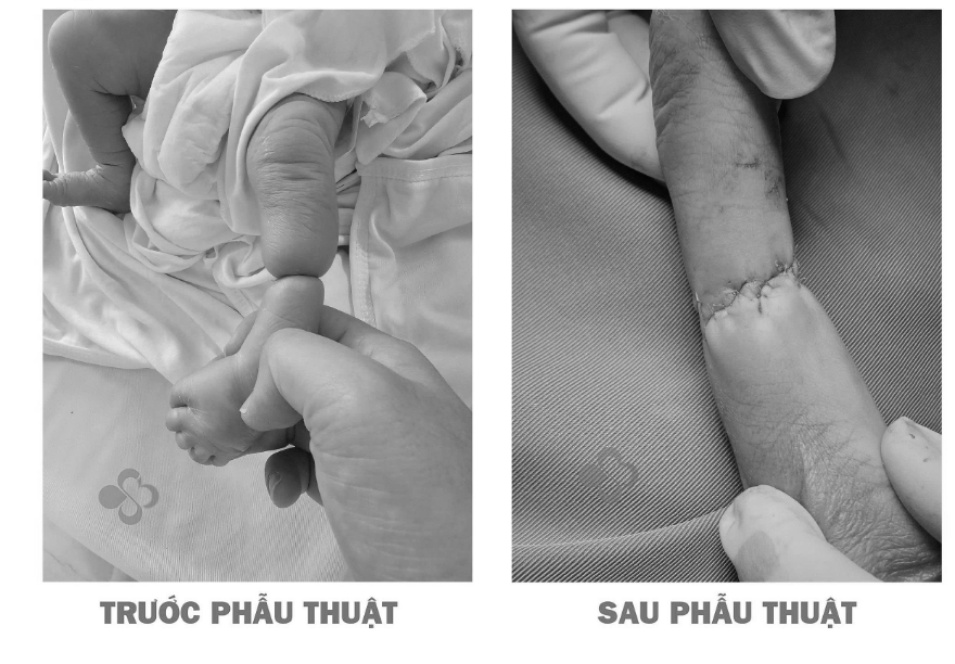 Hy hữu: Trẻ sơ sinh bị hội chứng dải sợi ối từ trong bụng mẹ thắt nghẹt cẳng chân  - Ảnh 1.