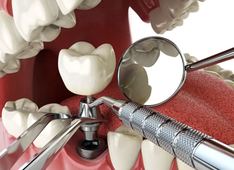 Người bệnh đái tháo đường có nên cấy implant ngay sau khi nhổ răng? - Ảnh 1.