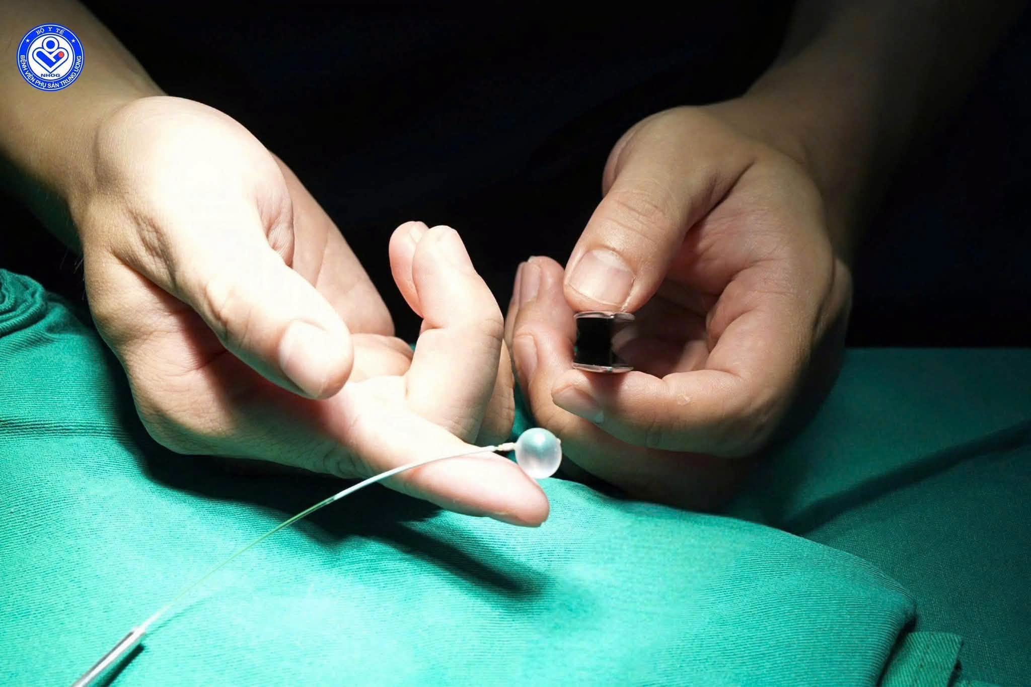 Lần đầu tiên tại Việt Nam: đặt bóng vào khí quản thai nhi 30 tuần tuổi, cứu trẻ từ trong bụng mẹ - Ảnh 1.