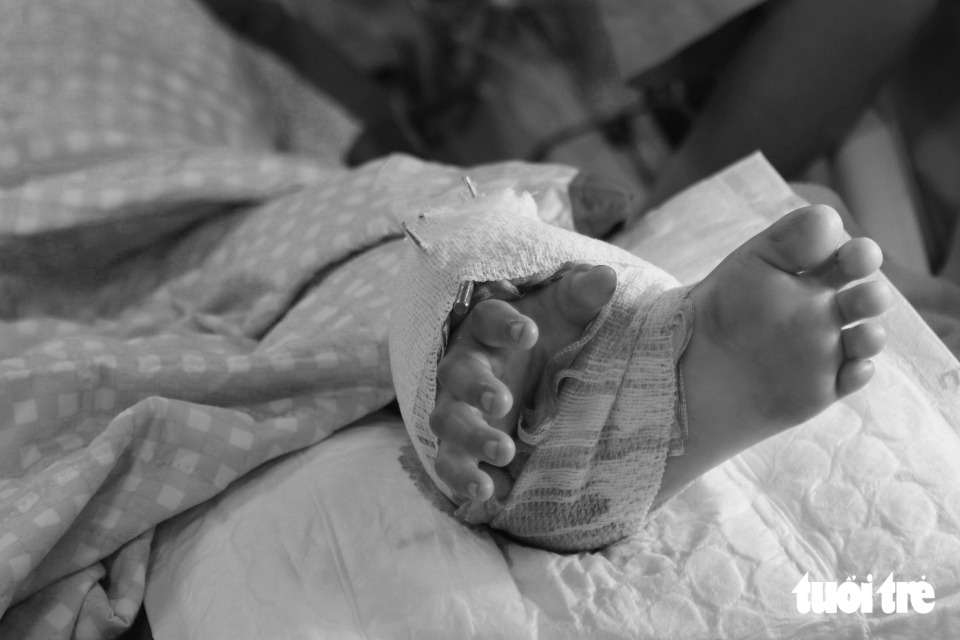 7 giờ phẫu thuật ghép tạm bàn tay vào chân bé trai bị cổng chào sập đè - Ảnh 2.