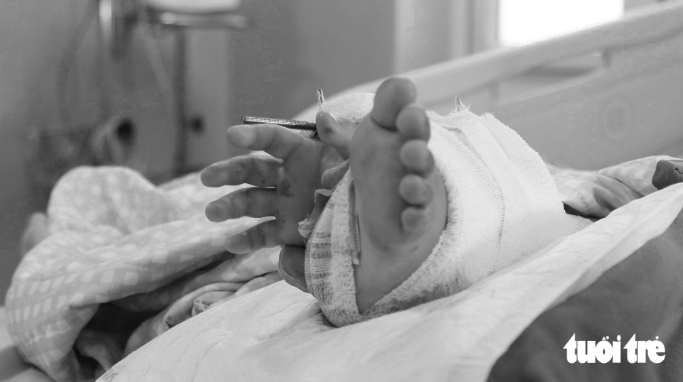 7 giờ phẫu thuật ghép tạm bàn tay vào chân bé trai bị cổng chào sập đè - Ảnh 3.