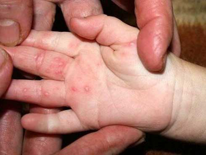 TP.HCM ghi nhận số ca tay chân miệng tăng mạnh, xuất hiện chủng virus nguy hiểm