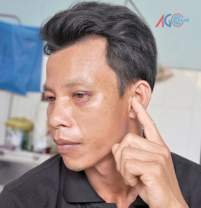 Cho thôi việc công an viên làm dân bị thủng màng nhĩ