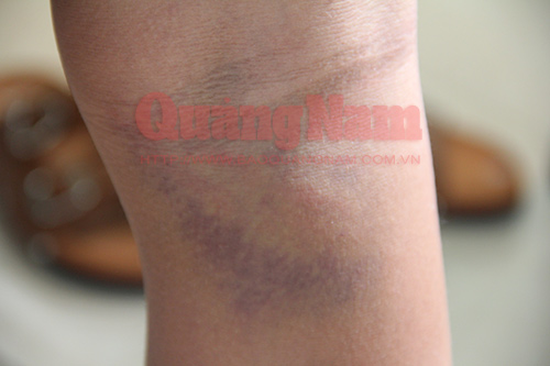 Vết thương trên chân em Múi đã bớt sưng, nhưng vẫn còn bầm tím sau nhiều ngày điều trị.