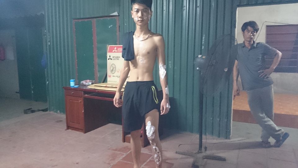 Một người d&acirc;n bị bỏng do bị axit hắt v&agrave;o