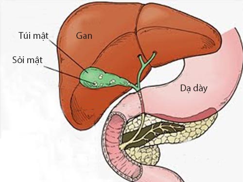 Kẻ thù của bệnh sỏi mật