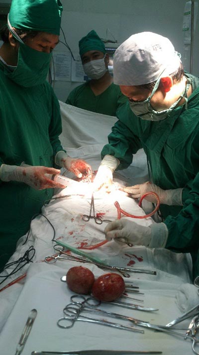 Hai vi&ecirc;n sỏi thận lớn hơn 2 quả trứng