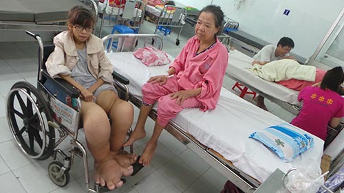 Thiếu nữ mắc bệnh “chân voi” hiếm gặp