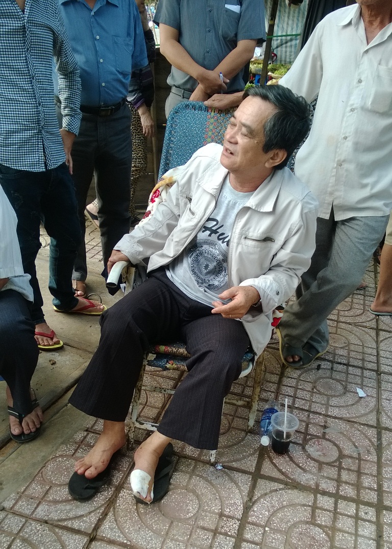 Ông Tòng bị phỏng nhiều nơi ở hai bàn chân