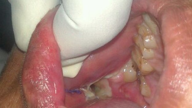 Qu&aacute; tr&igrave;nh phẫu thuật bỏ răng của Ashik